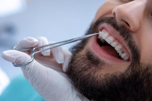 Dental Fillings at Tulip Dental Irvington